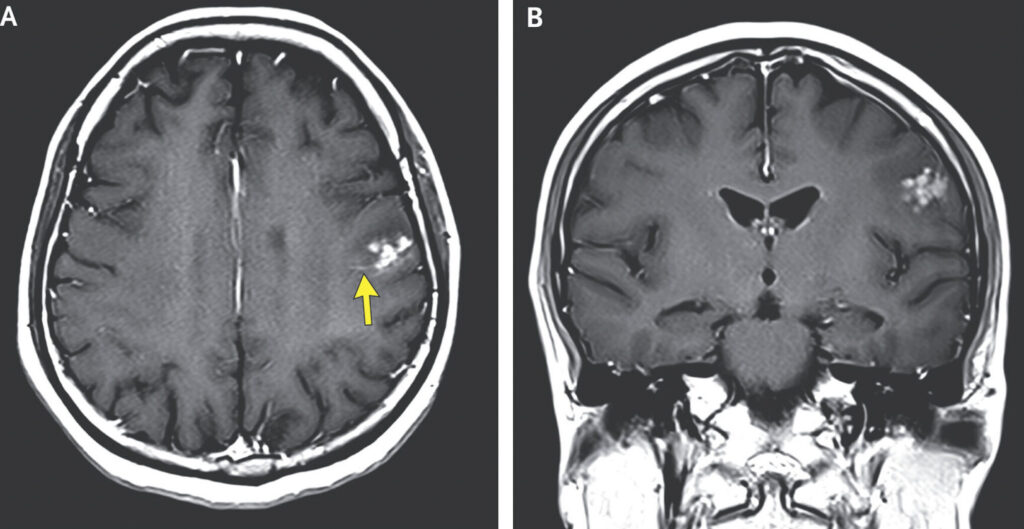 अचानक आधा शरीर काप्न थालेपछि अस्पताल पुगेकी महिला, MRI रिपोर्टले देखाएको डरलाग्दो दृश्य